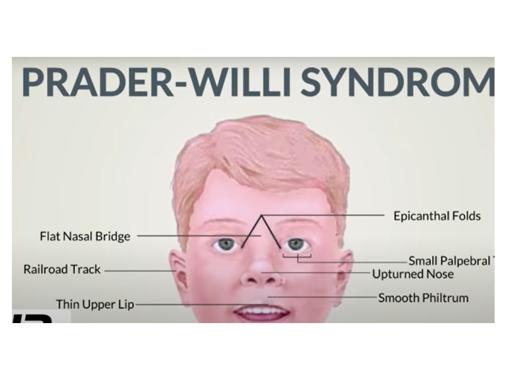 PRADER WILLI SYNDROME(PWDS), Causes, Signs and Symptoms, Diagnosis and Treatment.